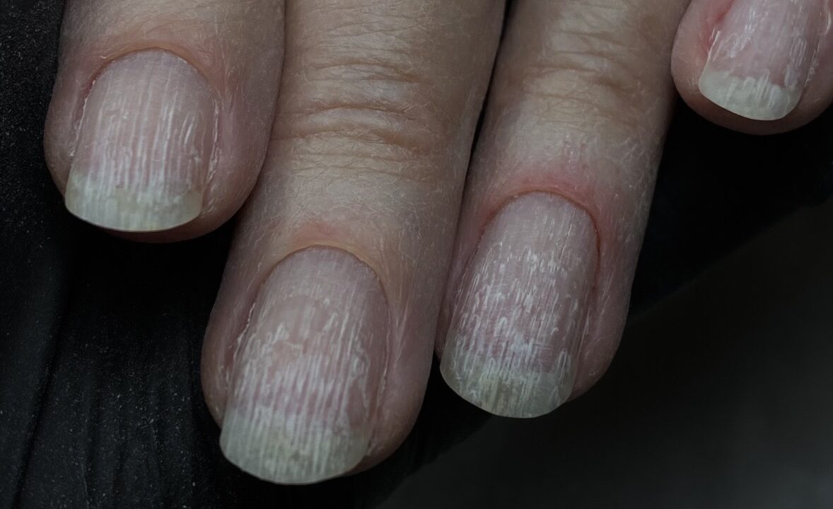 Uñas con estrías: Guía completa sobre causas, riesgos y el protocolo de NENHA