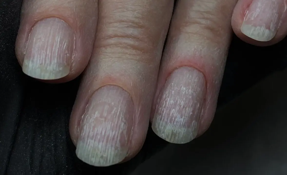 Uñas con estrías: Guía completa sobre causas, riesgos y el protocolo de NENHA