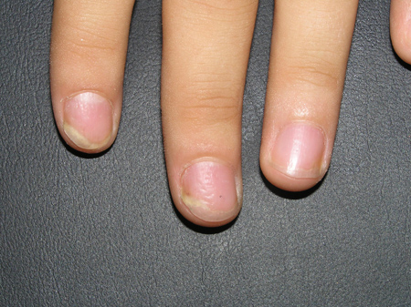 Manicura y Psoriasis: Guía maestra de seguridad, salud y estética responsable